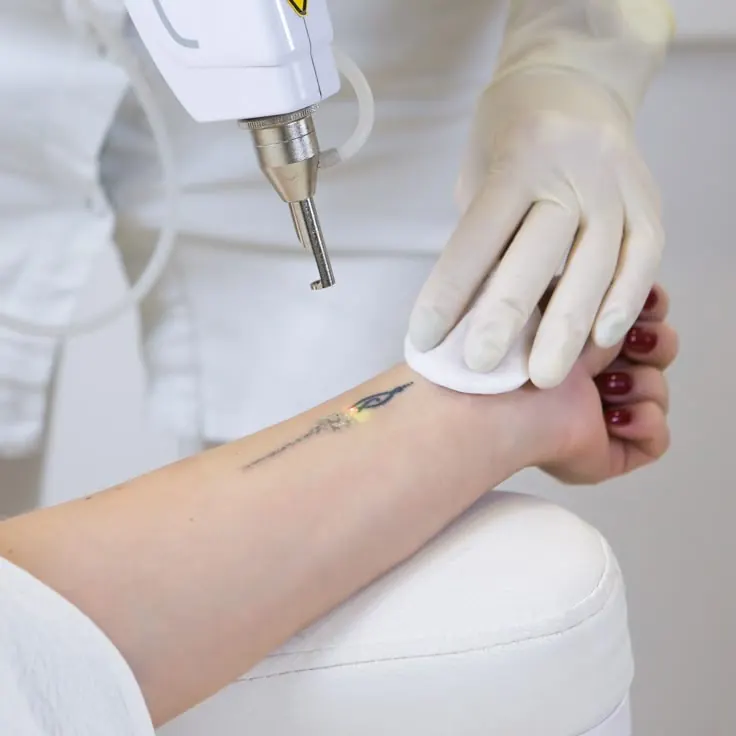 Laser Tattoo Removal treatment at Kira Exotica, a beauty salon in Indore